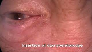 Lacrimal duct parameters based on dacryocystography  Supplementary video ID 370800 [upl. by Torbert477]