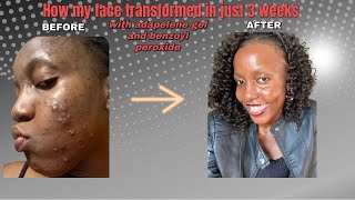 How my skin transformed in just 3 weeks of using adapalene gel and Benzoyl peroxide [upl. by Tilda495]