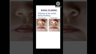 Nasal flaring  In tamil [upl. by Annaik]