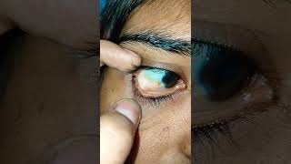 Conjunctival granuloma cyst chronic [upl. by Joeann592]