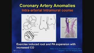 Adult Congenital Heart Disease Anomalous Coronary Arteries Risk Stratification [upl. by Nonaihr]