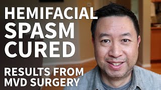 Hemifacial Spasm Surgery Recovery  Hemifacial Spasm Stories and MVD Surgery Cure [upl. by Colman719]