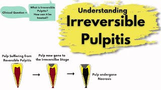 Irreversible Pulpitis  Causes Diagnosis and Treatment  Endodontics [upl. by Atteragram355]