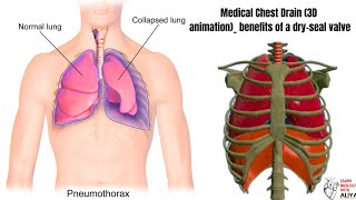 Medical Chest Drain 3D animation benefits of a dryseal valve  medical animation  3d video [upl. by Larina]