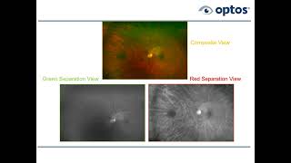 The Importance of Fundus Autofluorescence in Retinal Pathology Diagnosis [upl. by Netniuq]