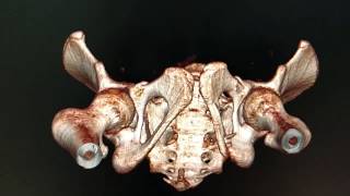 Tomografia  Fratura de Pelve  Contusão PulmonarTomography  Pelvic Fracture  Pulmonary Contusion [upl. by Conley235]