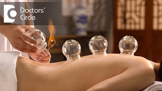 Is Cupping Therapy or Al Hijama painful  Dr Shagufta Siraj [upl. by Aniluj416]