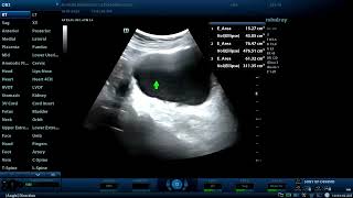 Multiple urinary bladder diverticula in chronic cystitis  Diagnostic ultrasound cases [upl. by Trilly]