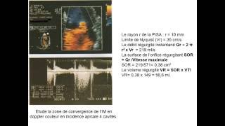 CARDIOLOGIE INSUFFISANCE MITRALE [upl. by Junia]