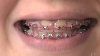 Orthodontic Care Videos  Disclosing Tablets [upl. by Latreese800]