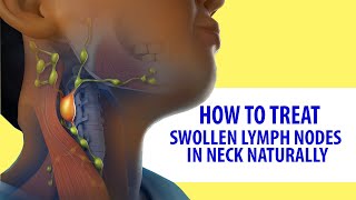 Quick and Easy Home Cure for Swollen Lymph Nodes nodes [upl. by Aplihs]