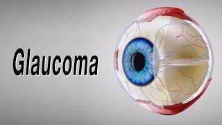 Glaucoma Animation of Why It Happens and How It Can Cause Blindness [upl. by Ulita]