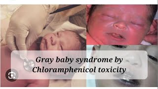 Gray baby syndrome by chloramphenicol toxicity pharmacology contraindications infants [upl. by Nnalorac]