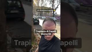 Trapianto di Capelli Giorno 40 Luce Naturale Rossore e Irritazioni 🚶‍♂️ [upl. by Ibot319]