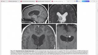 CORE REQUISITES of neuroradiology [upl. by Tiraj]