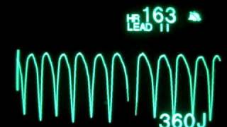 Pulseless Ventricular Tachycardia pVT  Monophasic Defibrillation at 360 Joules [upl. by Ayote]