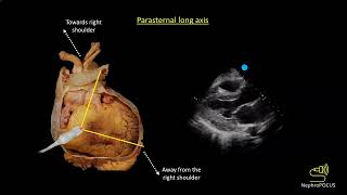 Basic cardiac ultrasound views I Dr Koratala NephroP [upl. by Justine]