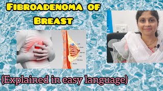 Fibroadenoma of Breast explained in simple language  Female Health  Treatment [upl. by Vod]