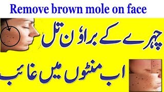 How to remove brown mole on face in Urdu  Anam Home Remedy [upl. by Linoel]