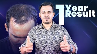 Hair Transplant in Bangladesh Fixing Grade 3 Baldness with 3000 Grafts Before amp After [upl. by Quackenbush]