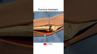 Hand bone fracture treatment  3D animation [upl. by Vada]