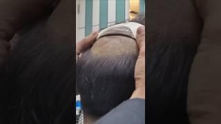 Permanent hair patch delhi  Best hair patch for mens hairfixing hairtutorial [upl. by Ermanno6]