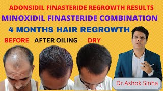 Best Hair Regrowth Treatment For Men [upl. by Enellij]