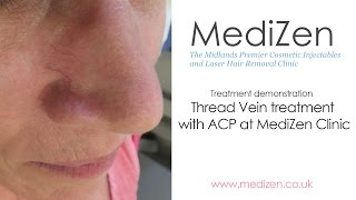 Treating Thread Veins with ACP at MediZen clinic Birmingham UK [upl. by Ahsital]