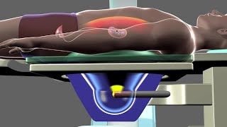 Shockwave Lithotripsy [upl. by Ewan]