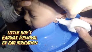 Little Boys Earwax Removal by Ear Irrigation [upl. by Ardnas552]