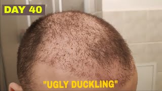 FUE Hair Transplant Results DAY 40  Hair of Istanbul [upl. by Enelime]