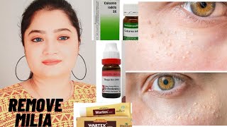 Milia Homeopathic Medicine For Milia Milium Cyst Explain By Anusuya Chakrabarti [upl. by Maison]