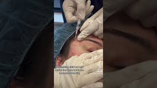 Subcision for Acne Scars of the Cheeks and Temples [upl. by Ylus]