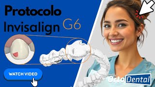 Invisalign G6 invisalignmexico alineadoresinvisibles extracciondental [upl. by Airtina]