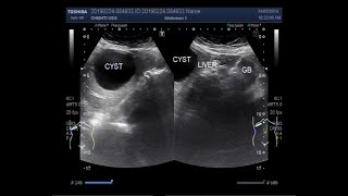 Hepatic Hydatid Cyst [upl. by Abrahamsen]