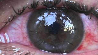 OffTopic Stitches of corneal graft  transplant  Incredible [upl. by Illil]