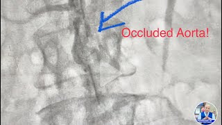 Occluded Aorta infrarenal CTO Revascularization of Aorta and Iliac artery  Lithotripsy amp stent [upl. by Matteo]