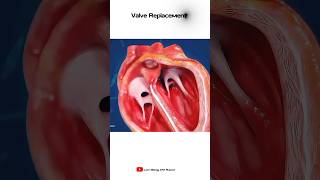 Heart Valve Replacement  Short animation [upl. by Ajnot]