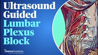 UltrasoundGuided Lumbar Plexus Block [upl. by Leodora]