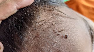 Remove all big lice from his hair  How to remove all hundred lice from his head [upl. by Etnod]