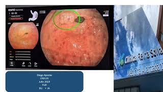 ACED IA en Endoscopia Nov 24 [upl. by Barnaba]