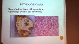 XanthoGranulomatis Pyelonephritis  Alexandra BENARROUS [upl. by Lerner]