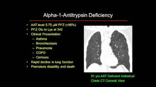 Alpha1 Antitrypsin Deficiency 101 Lung [upl. by Eillat]