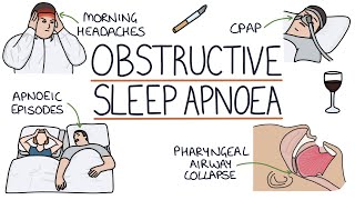 Obstructive Sleep Apnoea [upl. by Aicargatla]