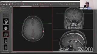 LIVE  Anatomia venosa intracraniana dicas práticas [upl. by Aznola]