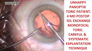 Unhappy Panoptix Toric Patient 4 Month Postop IOL Exchange Monofocal Toric StepWise Exchange [upl. by Ashely203]