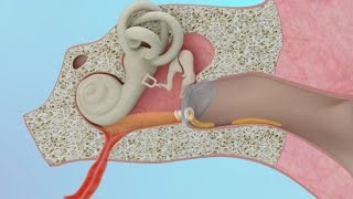 Clogged Ear Due to Ear Infection or Eustachian Tube Dysfunction [upl. by Fabrienne]