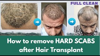 How to remove Hard Scabs after Hair Transplant  KV Hair Care amp Life [upl. by Albric]