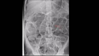 Rigler’s sign  Pneumoperitoneum [upl. by Esenej]