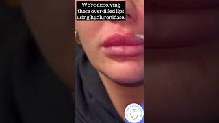 Dissolving Migrated Lip Filler [upl. by Ahsitel]